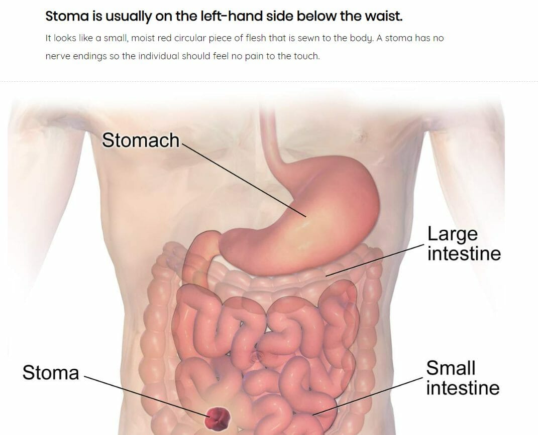 stoma screenshot 1 stoma screenshot 1